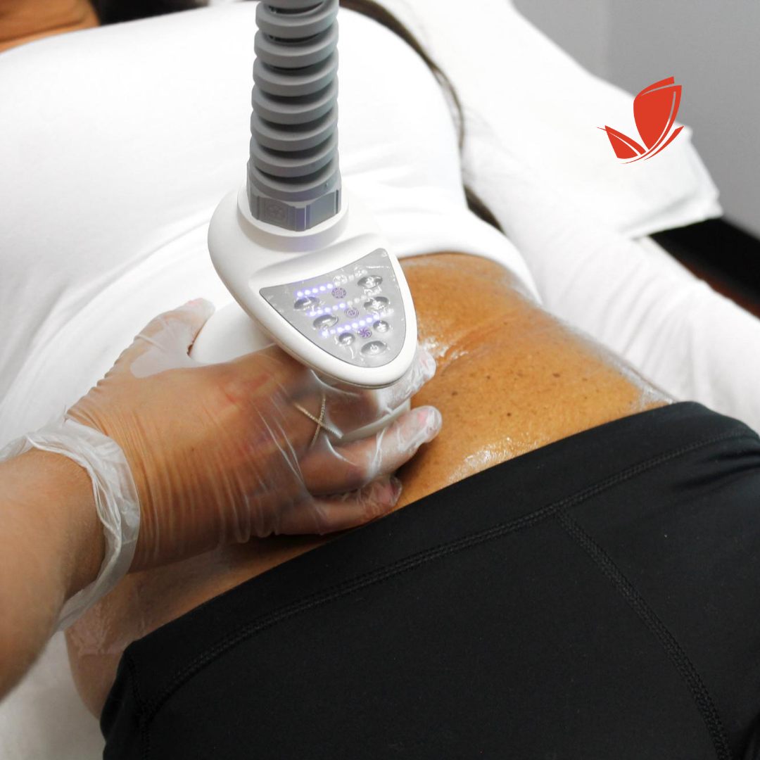 How to Get Rid of Cellulite and Stretch Marks? - Alite Laser